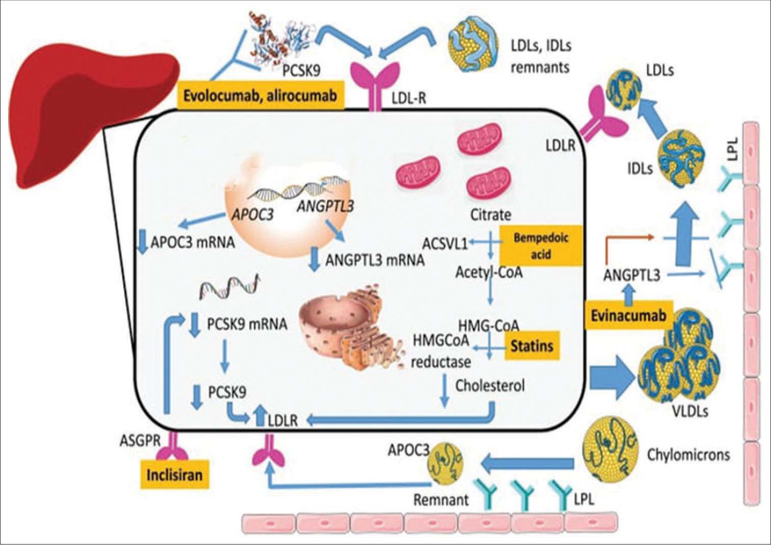 The methods of action of novel and existing treatments for primary hyperlipidemia. The mainstay of cardiovascular prophylaxis, statins, and target intracellular cholesterol concentrations. Reduced production of cholesterol leads to an increase in the amount of LDL-R in the membrane. The acyl-coenzyme A synthease-1 inhibitor bempedoic acid targets the same metabolic pathway, although it does so at a different stage. In addition, treatments based on PCSK9 modify this pathway by preventing LDLR from being destroyed by lysosomes. A short interfering RNA called inclisiran binds to the ASGPR and is directed against the PCSK9 mRNA. The drug’s tissue selectivity is attributed to the last characteristic, which is the high abundance of ASGPR in the liver – the organ where PCSK9 is mostly produced. The inclisiran-ASGPR complex is endocyted. After entering the cytoplasm, inclisiran interacts with PCSK9 mRNA through the antisense strand, which causes the mRNA to be eliminated by enzymes. An important inhibitor of LPL action is ANGPTL3. Anti-ANGPTL3 treatments enhance the clearance of plasma particles high in triglycerides. Evinacumab, a monoclonal antibody. Triglyceride-rich lipoprotein is recognized by its binding receptors through modulation of recognition by apolipoprotein CIII, which also reduces LPL activity. ANGPTL: Angiopoietin-like protein 3; ACSVL1: Acyl-coenzyme A synthease-1, APOC3: Apolipoprotein C-III, ASGPR: Asialoglycoprotein receptor, HMGCoA reductase: Hydroxymethylglutaryl coenzyme A reductase, IDLs, LDLs, LDLR, LPL: Lipoprotein lipase, PCSK9: Proprotein convertase subtilisinkexin type 9, and VLDLs: lipoproteins with a very low density are used to describe different types of lipoprotein lipase, mRNA: messenger RNA, LDLs: Low-density lipoproteins, LDL-R: Low-density lipoprotein receptor.