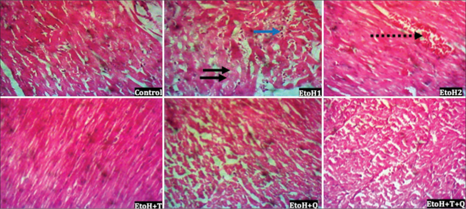 Photomicrograph of cardiac tissue showing focal loss of myofiber striation, degeneration (black arrows), a few infiltrate of inflammatory cells (blue arrow) and congestion (broken arrow); hematoxylin and eosin; Magnification ×400.