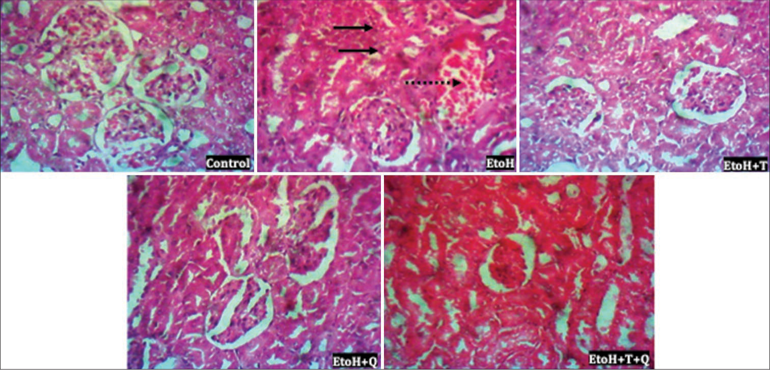 Photomicrograph of renal tissue showing patchy tubular necrosis and ectasia (thick black arrow) and congestion (broken arrow). Hematoxylin and eosin (H&E); Magnification ×400 Heart; H&E; Magnification ×400.