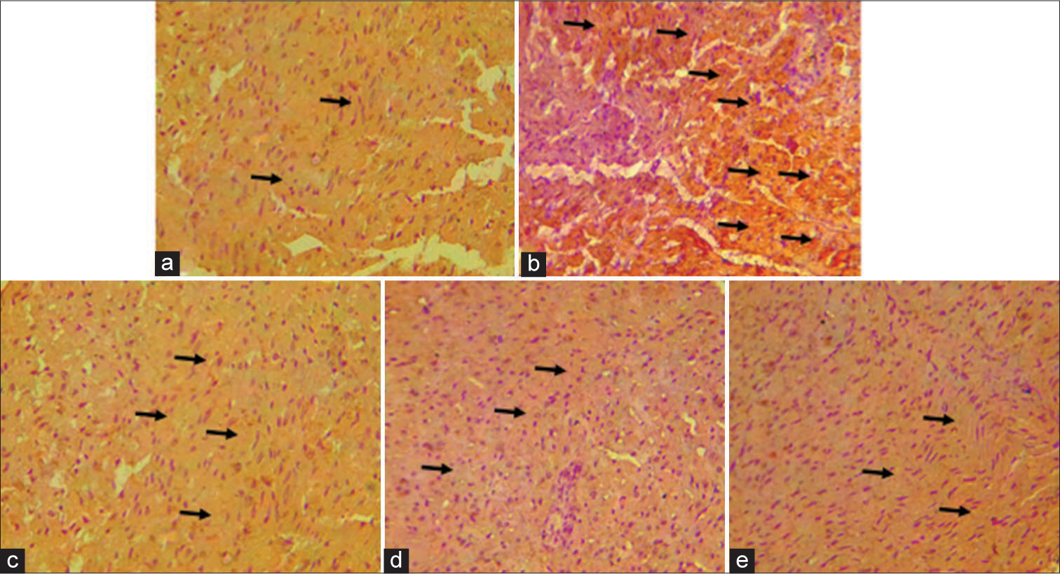 The immunohistochemistry of cardiac troponin. (a) Group A (Control), (b) Group B (Ethanol [EtoH] [40%]), (c) Group C (EtoH [40%] + alpha-tocopherol (2.5 mg/kg), (d) Group D (EtoH [40%] + quercetin 50 mg/kg), and (e) Group E (EtoH [40%] + alpha-tocopherol + quercetin 50 mg/kg). Black arrows indicate immunohistochemical expression of cardiac troponin. Slides stained with high definition hematoxylin. (Magnification ×100).